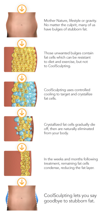 coolsculpting burnaby